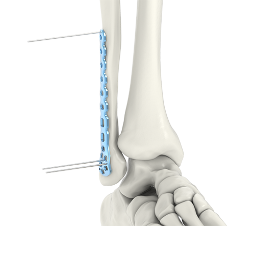 distal fibula 04