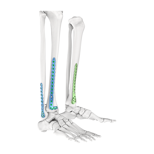 distal tibia 03