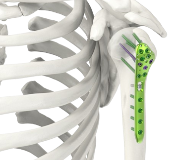 humerus system